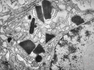 M,59y. | crystalline inclusions in plasmocyte - plasmocytoma